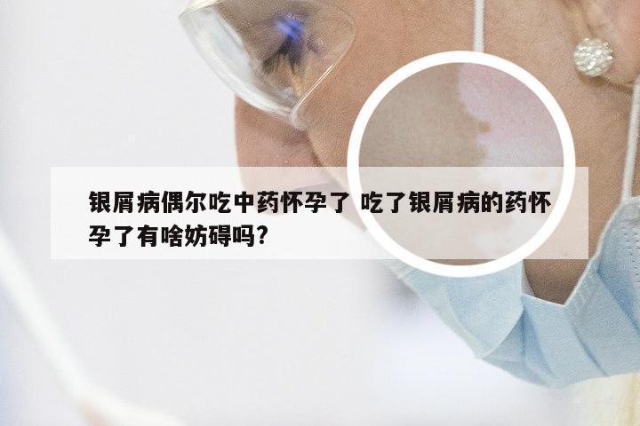 银屑病偶尔吃中药怀孕了 吃了银屑病的药怀孕了有啥妨碍吗?