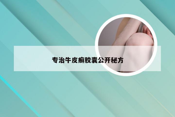 专治牛皮癣胶囊公开秘方