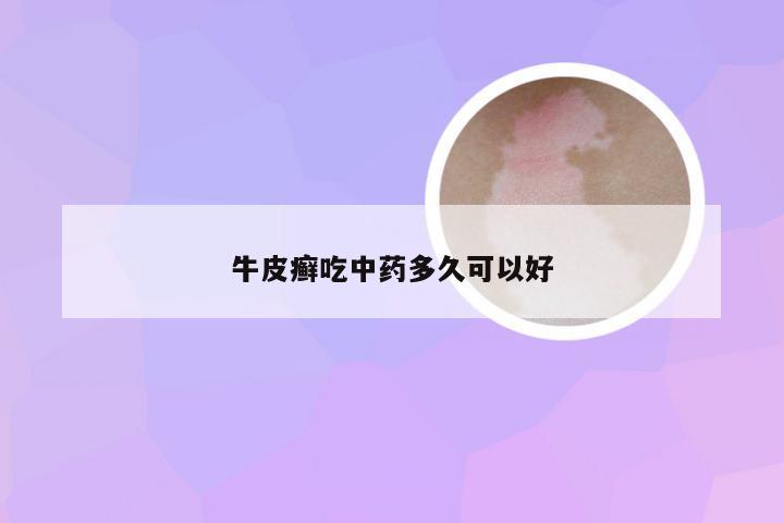 牛皮癣吃中药多久可以好