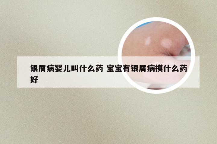 银屑病婴儿叫什么药 宝宝有银屑病摸什么药好