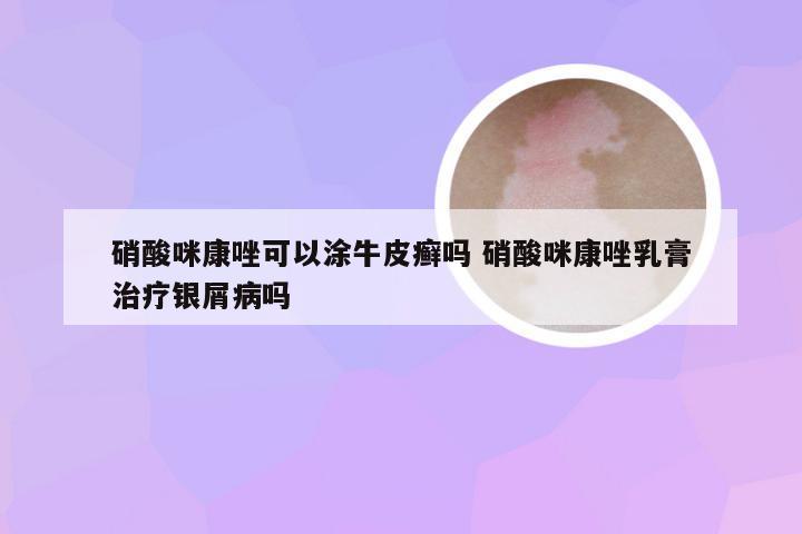 硝酸咪康唑可以涂牛皮癣吗 硝酸咪康唑乳膏治疗银屑病吗