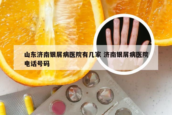 山东济南银屑病医院有几家 济南银屑病医院电话号码