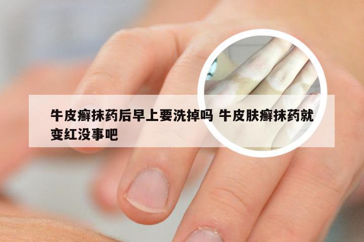 牛皮癣抹药后早上要洗掉吗 牛皮肤癣抹药就变红没事吧