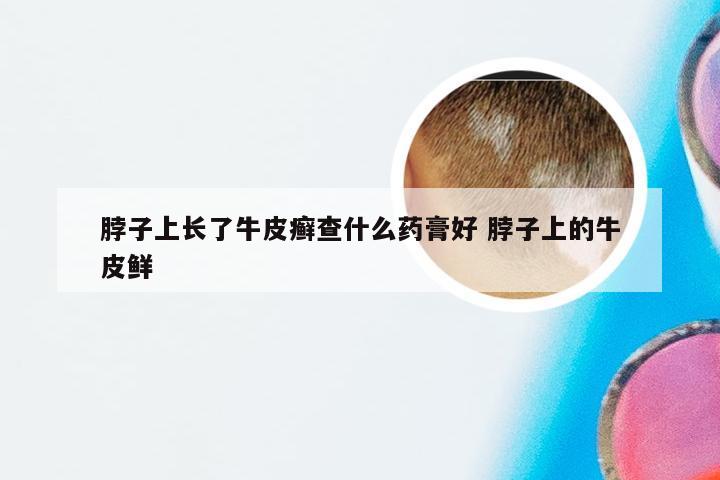 脖子上长了牛皮癣查什么药膏好 脖子上的牛皮鲜