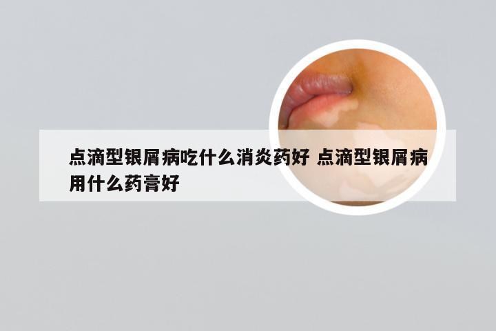 点滴型银屑病吃什么消炎药好 点滴型银屑病用什么药膏好