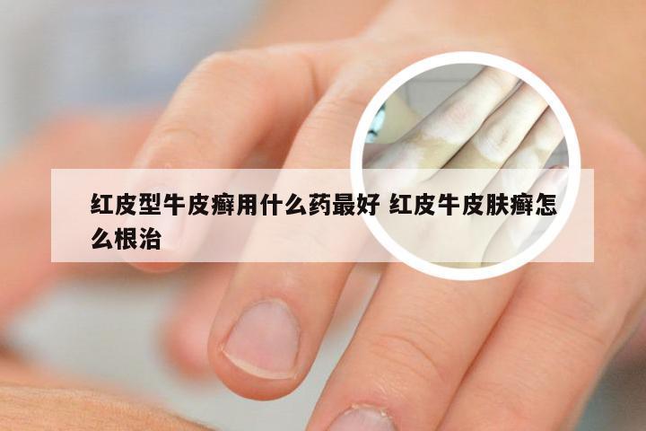 红皮型牛皮癣用什么药最好 红皮牛皮肤癣怎么根治