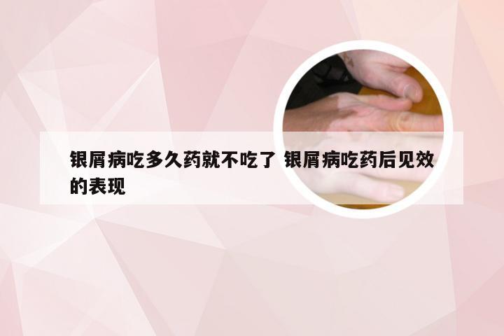 银屑病吃多久药就不吃了 银屑病吃药后见效的表现