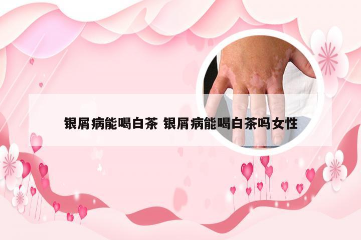 银屑病能喝白茶 银屑病能喝白茶吗女性