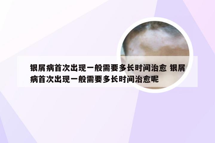 银屑病首次出现一般需要多长时间治愈 银屑病首次出现一般需要多长时间治愈呢