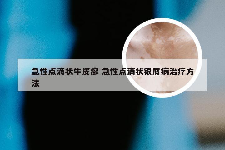 急性点滴状牛皮癣 急性点滴状银屑病治疗方法