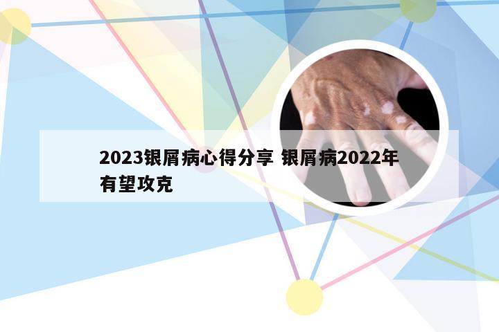 2023银屑病心得分享 银屑病2022年有望攻克