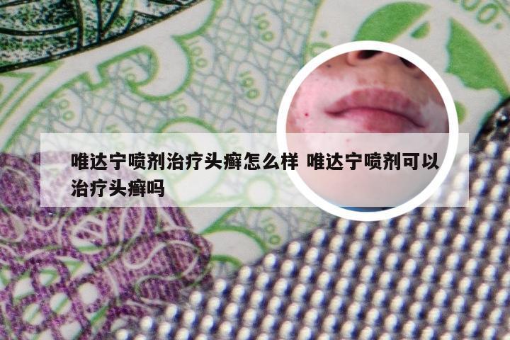 唯达宁喷剂治疗头癣怎么样 唯达宁喷剂可以治疗头癣吗