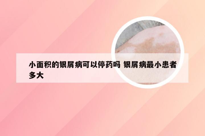 小面积的银屑病可以停药吗 银屑病最小患者多大