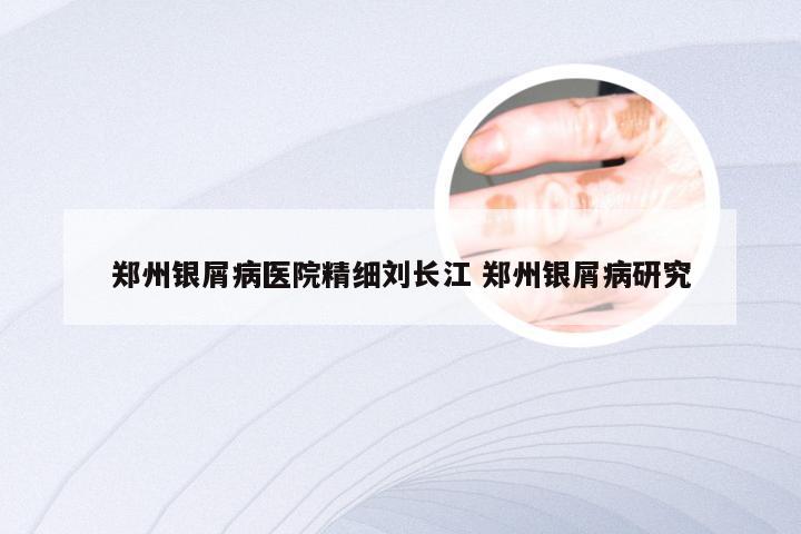 郑州银屑病医院精细刘长江 郑州银屑病研究