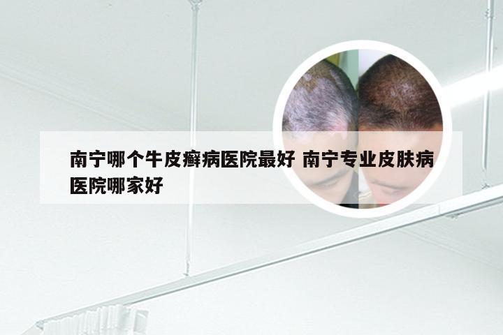 南宁哪个牛皮癣病医院最好 南宁专业皮肤病医院哪家好