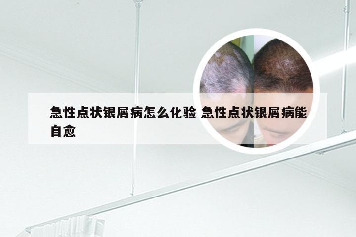 急性点状银屑病怎么化验 急性点状银屑病能自愈