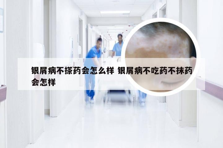 银屑病不搽药会怎么样 银屑病不吃药不抹药会怎样