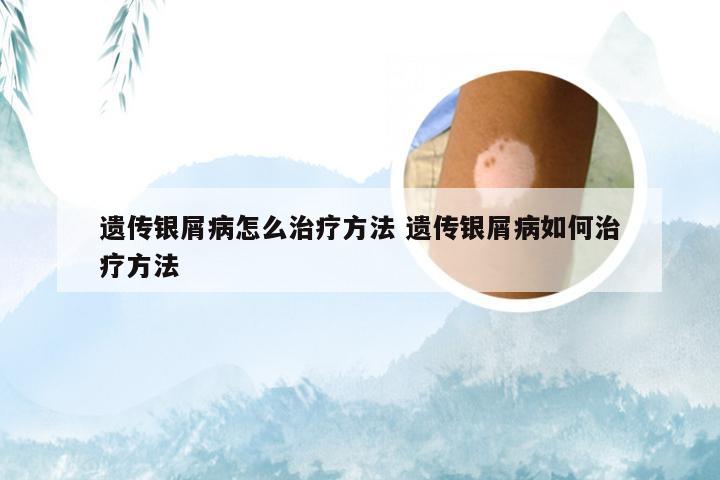 遗传银屑病怎么治疗方法 遗传银屑病如何治疗方法