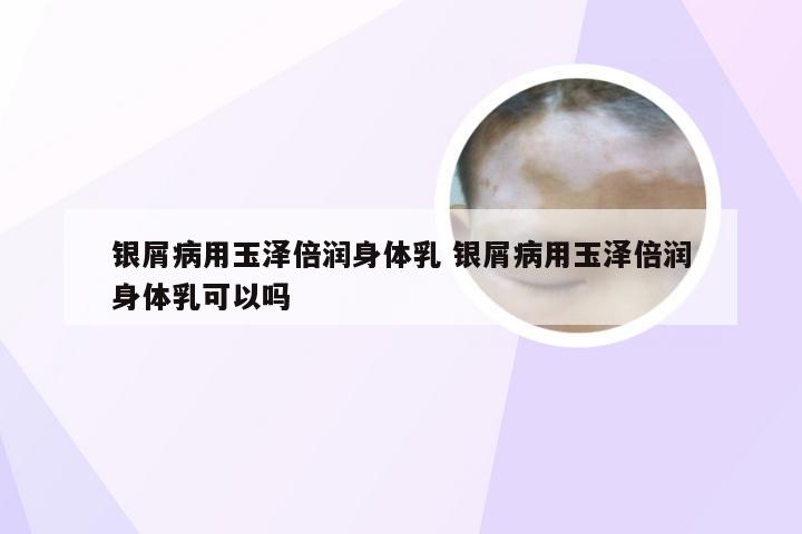 银屑病用玉泽倍润身体乳 银屑病用玉泽倍润身体乳可以吗