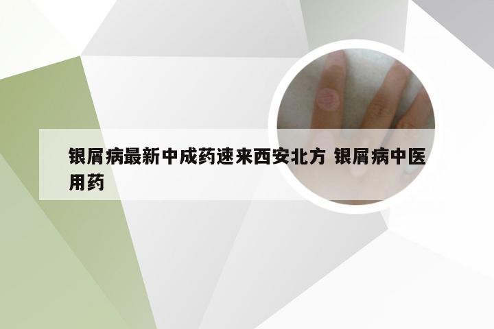 银屑病最新中成药速来西安北方 银屑病中医用药