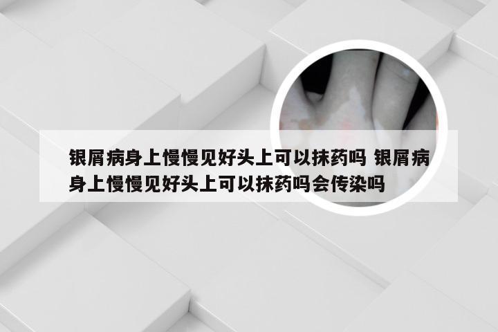 银屑病身上慢慢见好头上可以抹药吗 银屑病身上慢慢见好头上可以抹药吗会传染吗