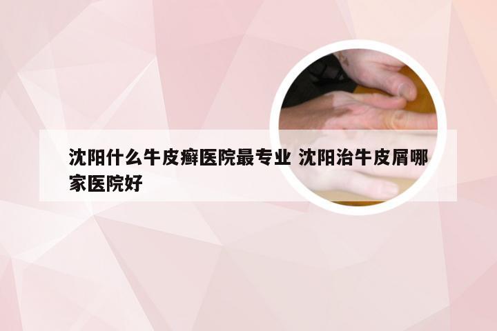 沈阳什么牛皮癣医院最专业 沈阳治牛皮屑哪家医院好