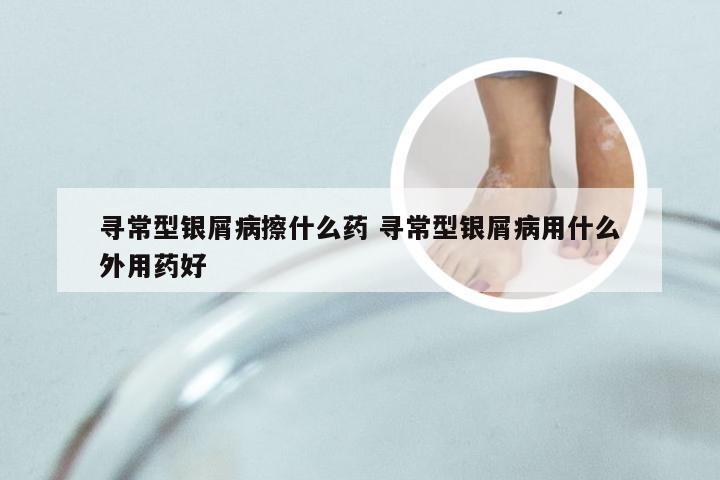 寻常型银屑病擦什么药 寻常型银屑病用什么外用药好