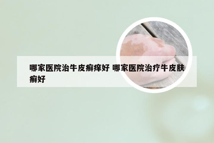 哪家医院治牛皮癣痒好 哪家医院治疗牛皮肤癣好