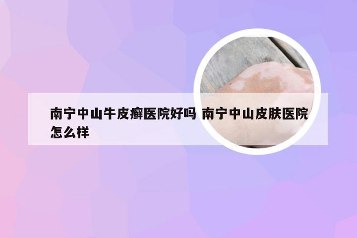 南宁中山牛皮癣医院好吗 南宁中山皮肤医院怎么样