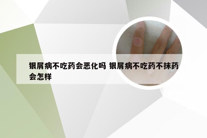 银屑病不吃药会恶化吗 银屑病不吃药不抹药会怎样