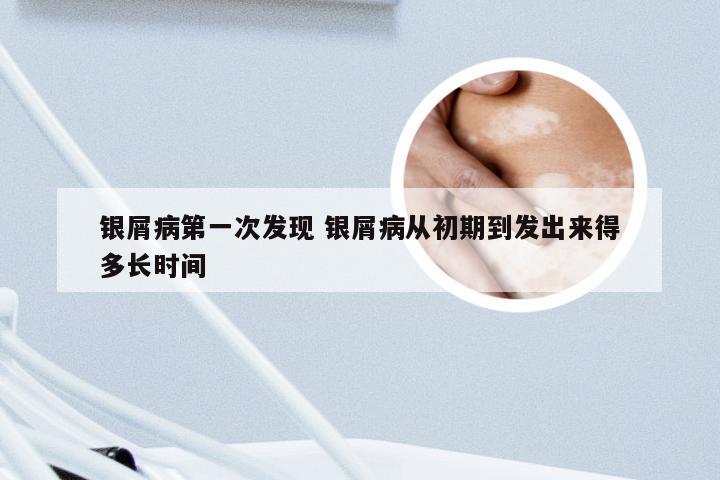 银屑病第一次发现 银屑病从初期到发出来得多长时间