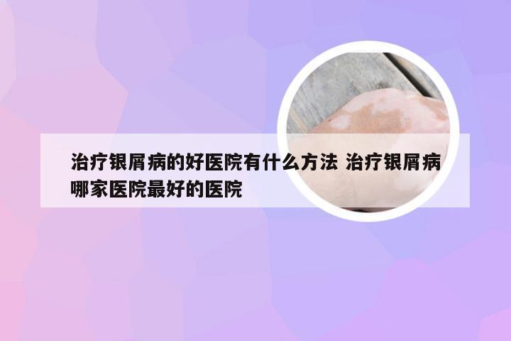 治疗银屑病的好医院有什么方法 治疗银屑病哪家医院最好的医院