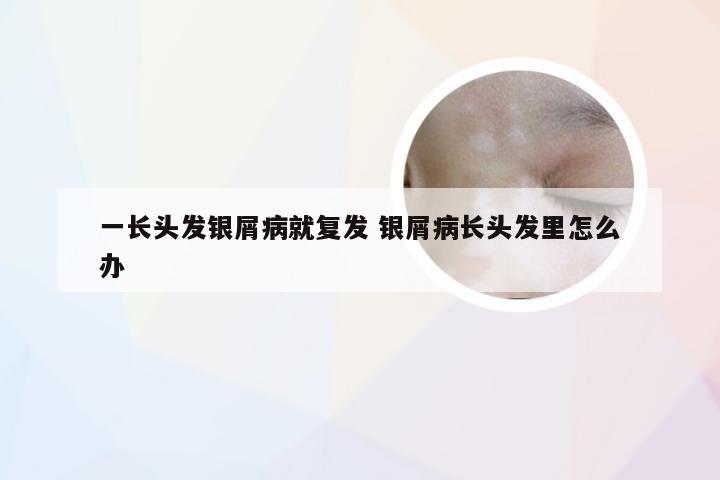 一长头发银屑病就复发 银屑病长头发里怎么办