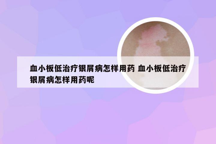 血小板低治疗银屑病怎样用药 血小板低治疗银屑病怎样用药呢