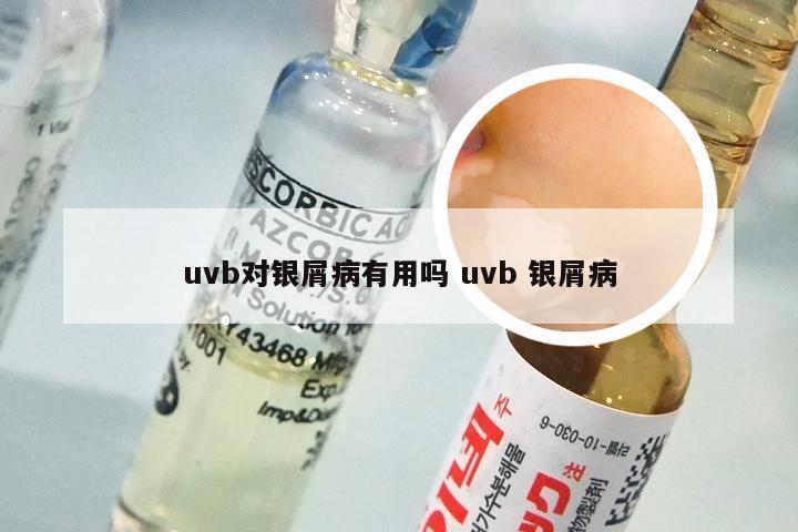 uvb对银屑病有用吗 uvb 银屑病