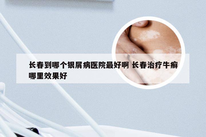 长春到哪个银屑病医院最好啊 长春治疗牛癣哪里效果好