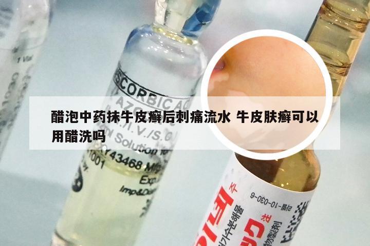 醋泡中药抹牛皮癣后刺痛流水 牛皮肤癣可以用醋洗吗