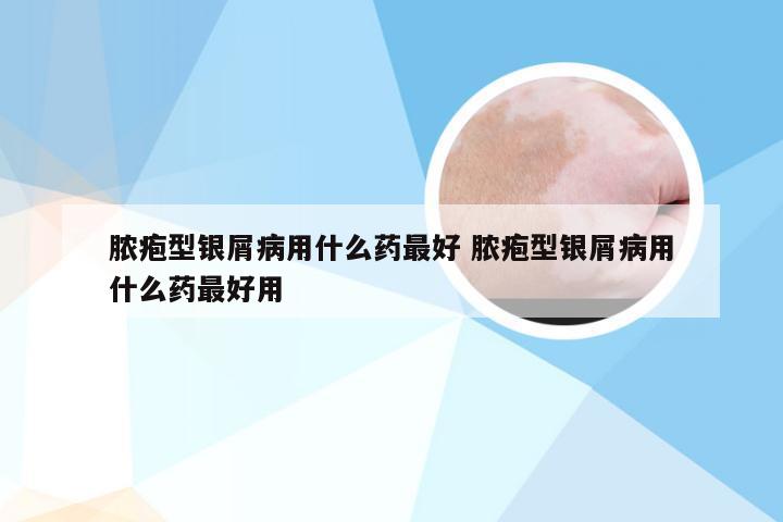 脓疱型银屑病用什么药最好 脓疱型银屑病用什么药最好用