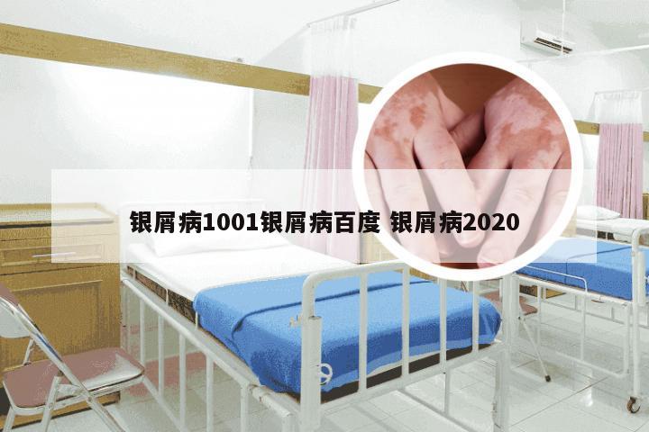 银屑病1001银屑病百度 银屑病2020