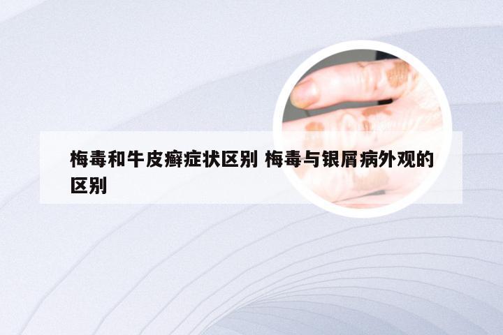 梅毒和牛皮癣症状区别 梅毒与银屑病外观的区别