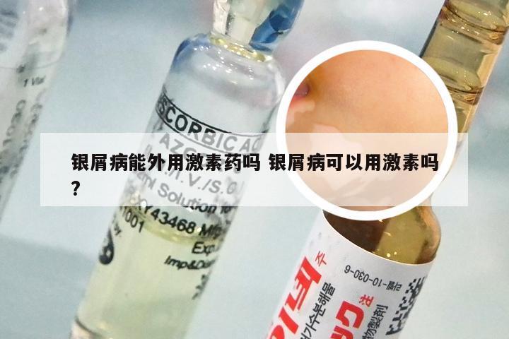 银屑病能外用激素药吗 银屑病可以用激素吗?