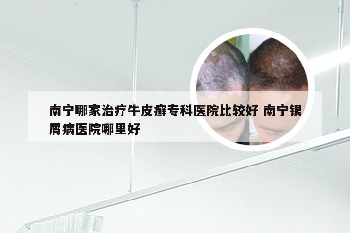 南宁哪家治疗牛皮癣专科医院比较好 南宁银屑病医院哪里好