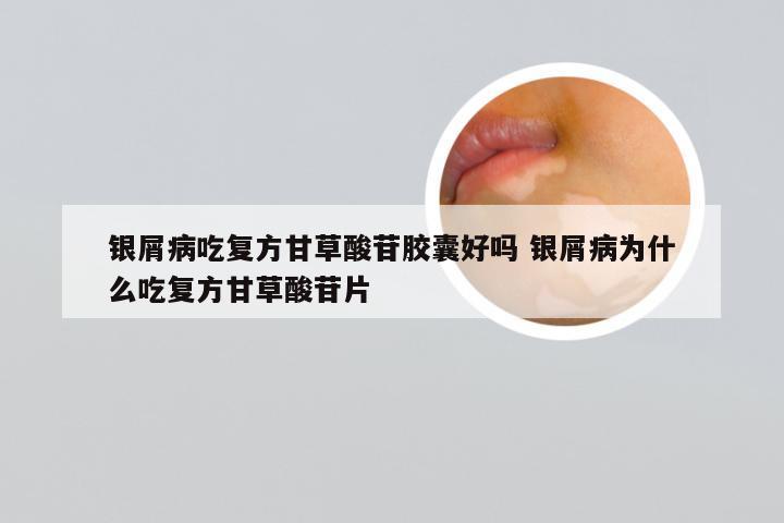 银屑病吃复方甘草酸苷胶囊好吗 银屑病为什么吃复方甘草酸苷片