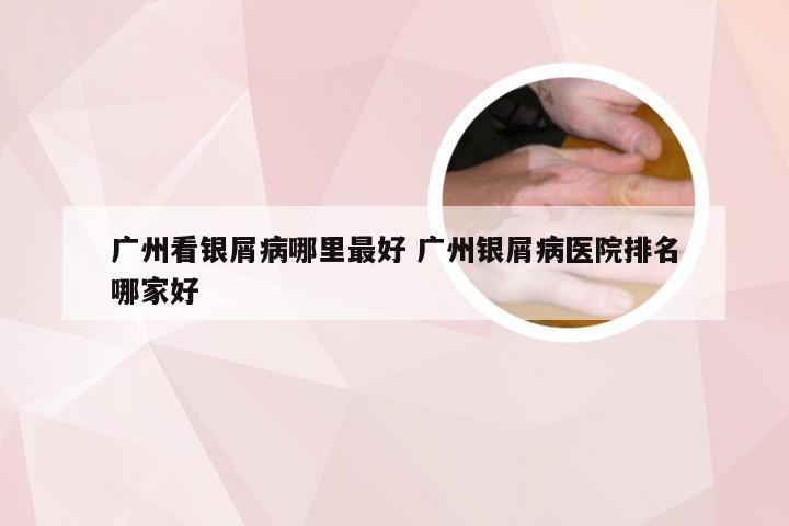 广州看银屑病哪里最好 广州银屑病医院排名哪家好