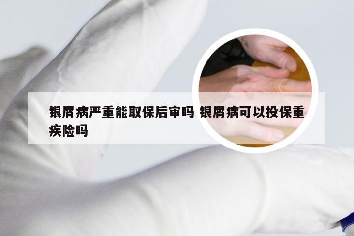 银屑病严重能取保后审吗 银屑病可以投保重疾险吗