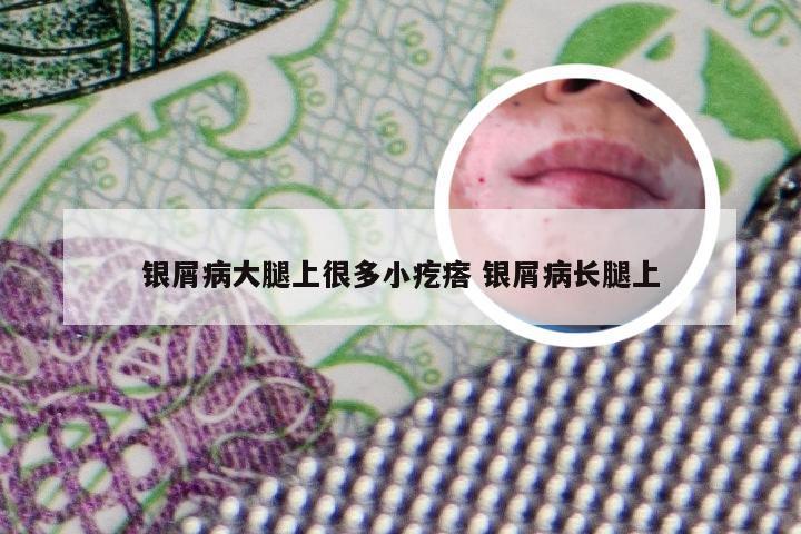 银屑病大腿上很多小疙瘩 银屑病长腿上