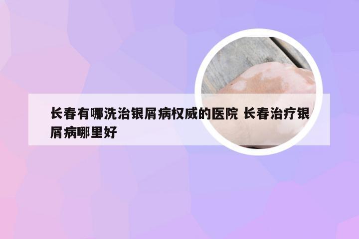 长春有哪洗治银屑病权威的医院 长春治疗银屑病哪里好