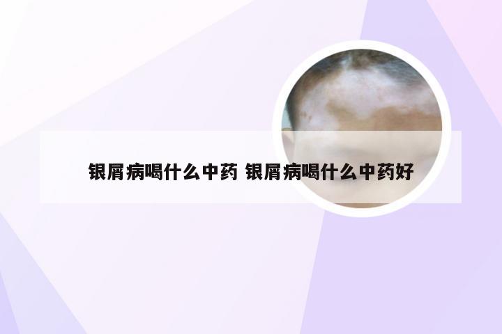 银屑病喝什么中药 银屑病喝什么中药好