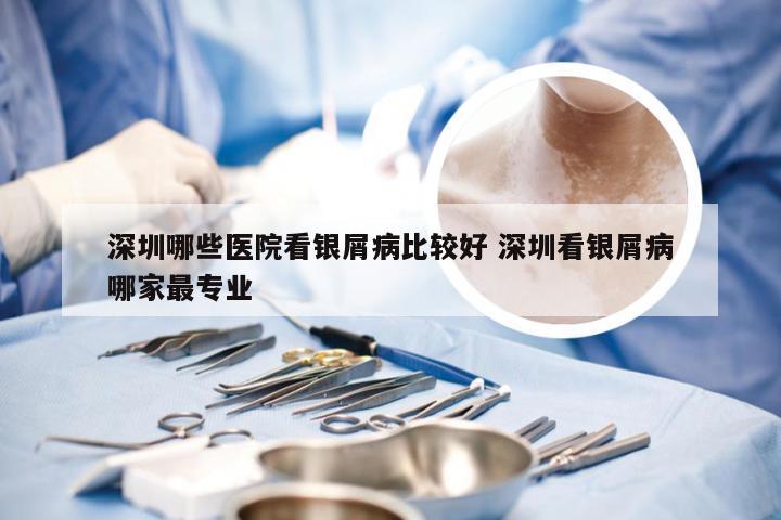 深圳哪些医院看银屑病比较好 深圳看银屑病哪家最专业