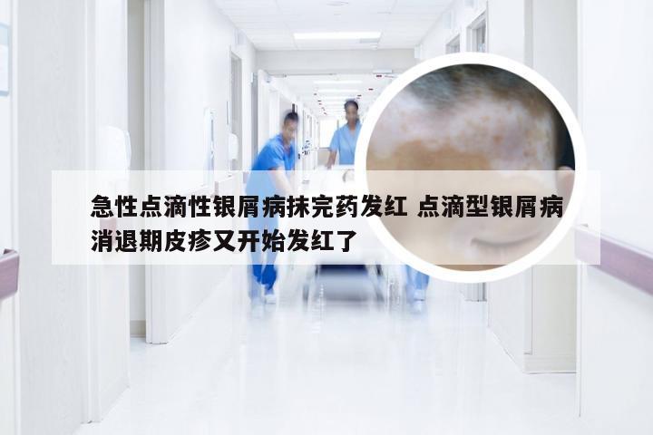 急性点滴性银屑病抹完药发红 点滴型银屑病消退期皮疹又开始发红了